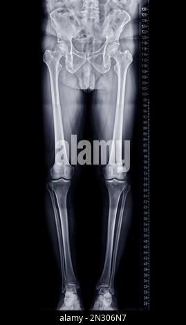 Lo Scanogram è una radiografia AP verticale su tutta la lunghezza di entrambe le estremità inferiori, inclusi anca, ginocchio e caviglia. Foto Stock