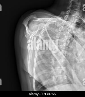 Radiografia visione transcapolare dell'articolazione della spalla per diagnosi di frattura dell'articolazione della spalla. Foto Stock