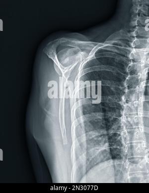 Radiografia visione transcapolare dell'articolazione della spalla per diagnosi di frattura dell'articolazione della spalla. Foto Stock