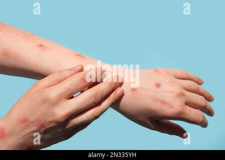 Monkeypox nuova malattia pericolosa in tutto il mondo. Paziente con vaiolo scimmia. Eruzione cutanea dolorosa, macchie rosse sulla mano. Primo piano rash, mani umane con Foto Stock