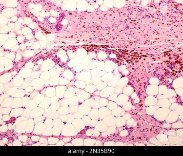 Grasso peritoneale che mostra macrofagi marcati con ferro colloidale. Il ferro colloidale può essere utilizzato come colorante vitale per marcare i macrofagi. Colloidale circolante Foto Stock