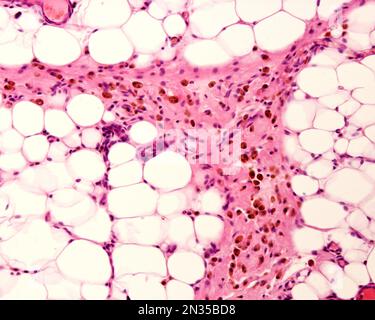 Grasso peritoneale che mostra macrofagi marcati con ferro colloidale. Il ferro colloidale può essere utilizzato come colorante vitale per marcare i macrofagi. Colloidale circolante Foto Stock