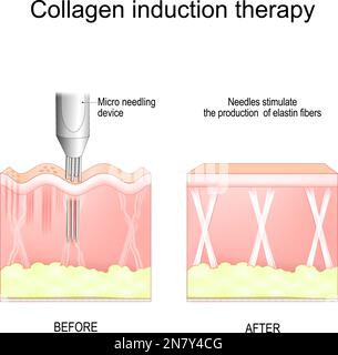 Terapia di induzione del collagene. microneedling. procedura di agugliatura della pelle per rimuovere rughe, cicatrici, stiramento, macchie, pigmentazione. perforando ripetutamente Illustrazione Vettoriale