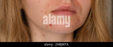 Donna irriconoscibile che mostra la sua acne sulla faccia. Acne di primo piano sul viso della donna con pelle rash, cicatrice e spot che allergico ai cosmetici. Banner problema skincare e concetto di salute. Rughe, melasma, macchie scure, lentiggini, pelle secca, i blackheads dell'acne sulla faccia le donne di mezza età problema dell'acne del mento. pimples sulla pelle di problema di barba. in una ragazza giovane. il disequilibrio ormonale. I disturbi della pelle portano alla depressione e alle insicurezze nelle donne Foto Stock