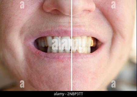 Prima e dopo la procedura di sbiancamento dei denti. Foto Stock