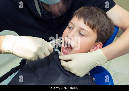 Primo piano di un ragazzo in una clinica dentale. Un medico che fa una procedura di estrazione di un dente con le pinze dentali Foto Stock