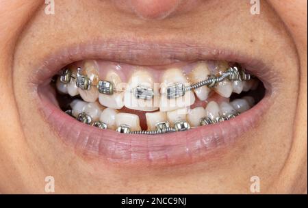 Bretelle in metallo sui denti della donna di mezza età indiana (britannica asiatica), solo bocca. Foto Stock