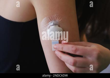 Inserito sensore glicemia con trasmettitore e adesivo adesivo Foto Stock