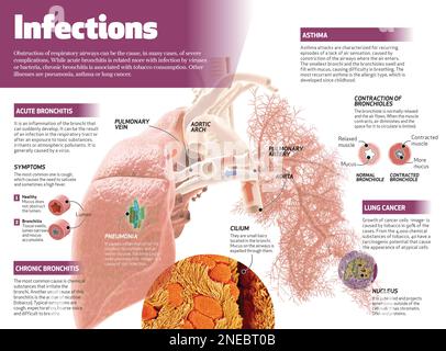 Infografica sulle infezioni nelle vie aeree. [Adobe InDesign (.indd); 4795x3543]. Foto Stock