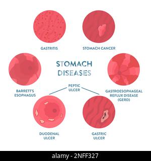 Malattie dello stomaco rilevate da procedura medica endoscopica Illustrazione Vettoriale