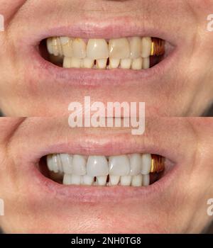 Prima e dopo la procedura di sbiancamento dei denti. Foto Stock