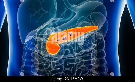 Pancreas o cancro pancreatico con organi e tumori o cellule cancerose 3D che rendono illustrazione con il corpo maschile. Anatomia, oncologia, malattia, medico, Foto Stock