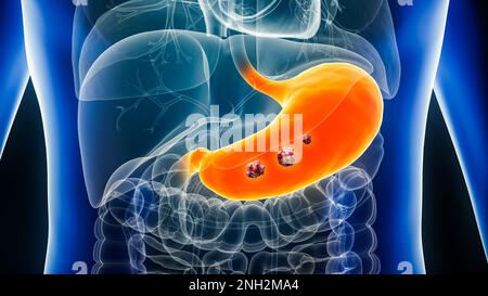 Cancro dello stomaco o dello stomaco con organi e tumori o cellule cancerose 3D che rendono illustrazione. Anatomia, oncologia, biomedica, malattia, medico, biolog Foto Stock