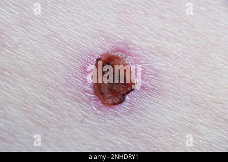 guarigione della ferita con scab dopo trattamento laser del cancro della pelle delle cellule basali Foto Stock