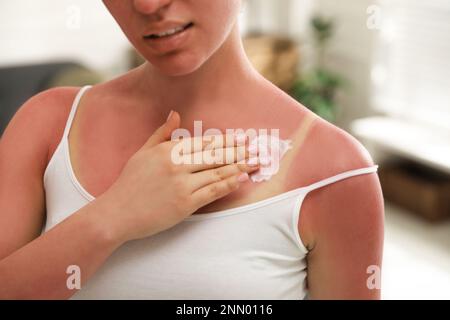 Donna che applica crema su scottature da sole a casa, primo piano Foto Stock