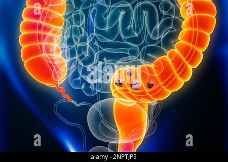 Cancro del colon o dell'intestino crasso con organi e tumori o cellule cancerose 3D che rendono illustrazione. Anatomia, oncologia, malattie intestinali, medico, biolo Foto Stock