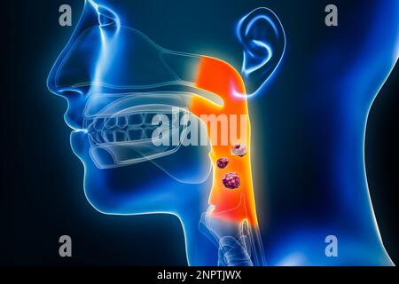 Cancro faringeo o della gola con organi e tumori o cellule cancerose 3D che rendono illustrazione. Anatomia, oncologia, faringe malattia, medico, biologia, Foto Stock