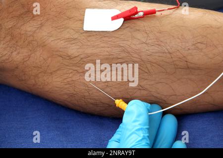 Elettromiografia EMG e potenziale evocato somatosensoriale PEV delle estremità inferiori, test neurofisiologico applica stimoli elettrici in prossimità dei nervi Foto Stock