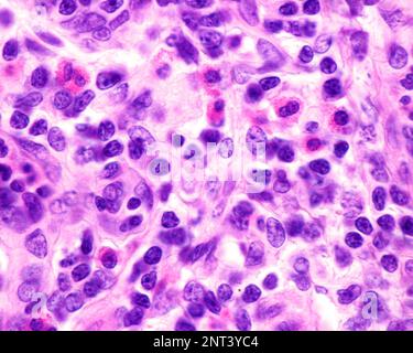 Micrografia al microscopio ottico che mostra granulociti eosinofili nella lamina propria di un'appendice infiammata. Queste cellule contengono granuli rossi abbondanti ( Foto Stock