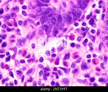 Micrografia al microscopio ottico che mostra granulociti eosinofili nella lamina propria di un'appendice infiammata. Queste cellule contengono granuli rossi abbondanti ( Foto Stock