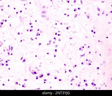 Le cellule plasmatiche sono linfociti B attivati dalla presenza di antigeni che secernono grandi quantità di anticorpi. Compaiono nei tessuti affetti da c Foto Stock
