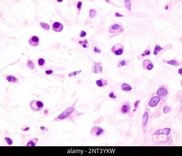 Le cellule plasmatiche sono linfociti B attivati dalla presenza di antigeni che secernono grandi quantità di anticorpi. Compaiono nei tessuti affetti da c Foto Stock