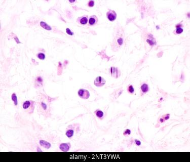 Le cellule plasmatiche sono linfociti B attivati dalla presenza di antigeni che secernono grandi quantità di anticorpi. Compaiono nei tessuti affetti da c Foto Stock