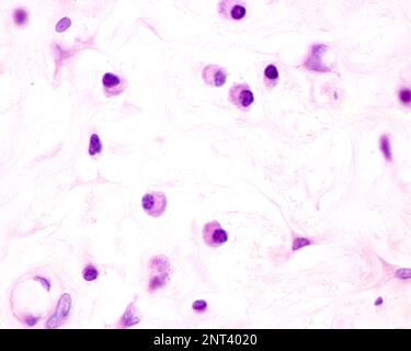 Le cellule plasmatiche sono linfociti B attivati dalla presenza di antigeni che secernono grandi quantità di anticorpi. Compaiono nei tessuti affetti da c Foto Stock