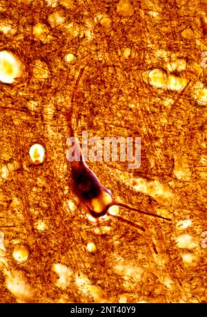 Micrografia leggera di una corteccia cerebrale umana di un cervello senile, colorata con un metodo dell'argento, che mostra un grande deposito di lipofuscina in una n piramidale Foto Stock
