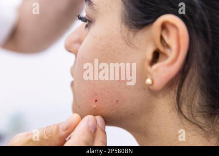 Trattamento dell'ago a secco. Un ritratto di un piccolo ago di agopuntura che si attacca nel viso di una persona accanto al naso, per guarire il dolore, alleviare lo stress o un altro m. Foto Stock