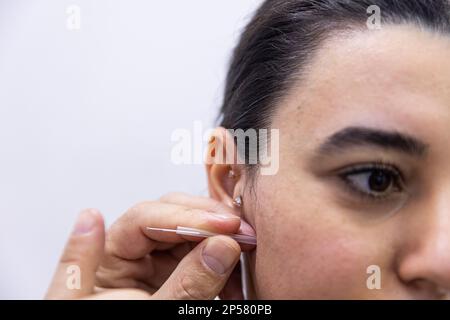 Trattamento dell'ago a secco. Un ritratto di un piccolo ago di agopuntura che si attacca nel viso di una persona accanto al naso, per guarire il dolore, alleviare lo stress o un altro m. Foto Stock