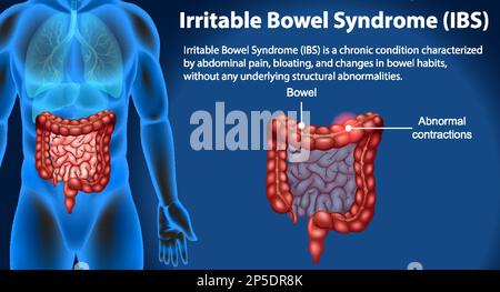 Illustrazione infografica della sindrome dell'intestino irritabile (IBS) Illustrazione Vettoriale