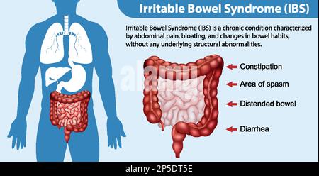 Illustrazione infografica della sindrome dell'intestino irritabile (IBS) Illustrazione Vettoriale