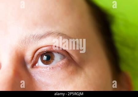 Malattia di orzo nell'occhio. Palpebra irritata. Foto Stock