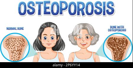 Confronto tra osso normale e osso con Osteoporosi nelle persone anziane illustrazione Illustrazione Vettoriale