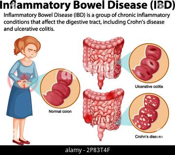 Infografica sulla malattia infiammatoria intestinale (IBD) Illustrazione Vettoriale