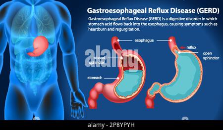 Malattia da reflusso gastroesofageo (GERD) illustrazione del diagramma Illustrazione Vettoriale