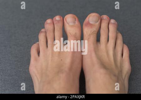 capelli e pimples sulle punte degli uomini Foto Stock