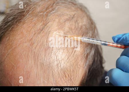 iniezione calvo trattamento capelli uomo Foto Stock