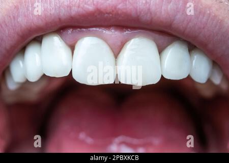 Maschio caucasico a bocca aperta che mostra una fila di denti bianchi e la parte posteriore della gola. Primo piano scatto macro, volto irriconoscibile. Foto Stock