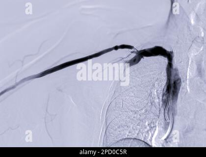 Immagine di angioplastica, angioplastica a palloncino e angioplastica transluminale percutanea (PTA). Foto Stock