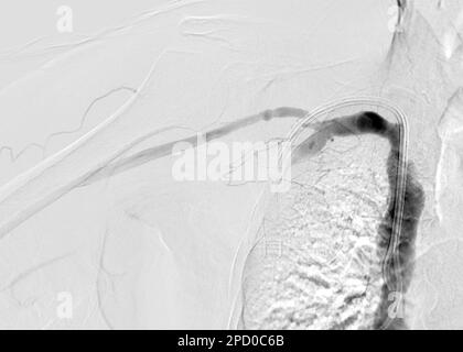 Immagine di angioplastica, angioplastica a palloncino e angioplastica transluminale percutanea (PTA). Foto Stock