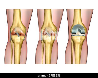 Anatomia sana del ginocchio, artrite degenerativa del ginocchio e chirurgia sostitutiva. Illustrazione digitale. Foto Stock