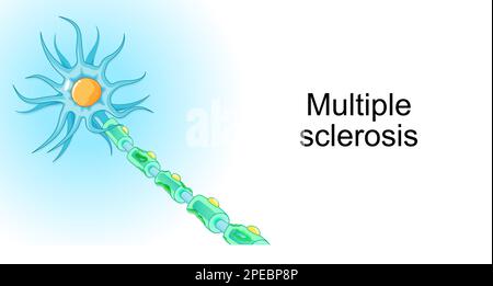 Sclerosi multipla. malattia demielinizzante. malattia autoimmune. Illustrazione vettoriale per poster o banner sulla Giornata Mondiale della sclerosi multipla. Illustrazione Vettoriale