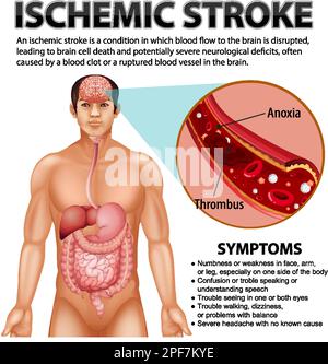 Poster informativo dell'illustrazione dell'ictus ischemico Illustrazione Vettoriale