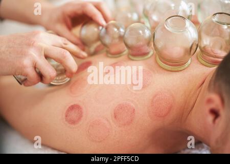 Un'immagine di un uomo che ha la terapia di cupping Foto Stock