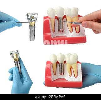 Dentisti che mostrano modelli educativi di impianti dentali su sfondo bianco, primo piano. Collage Foto Stock