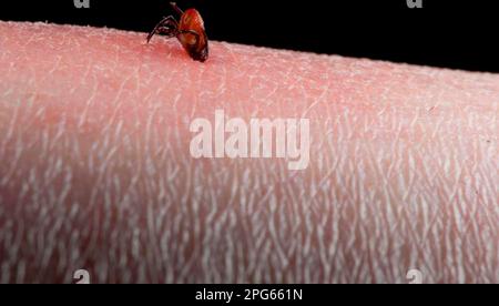 Tick (Acarina sp.) Adulto, alimentazione, su pelle umana con infiammazione, Inghilterra, Regno Unito Foto Stock