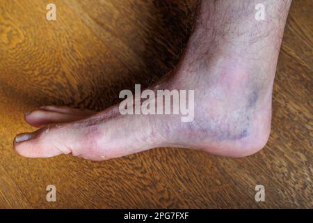 Grandi lividi nel tallone del piede dopo una lesione da stiramento. Foto Stock