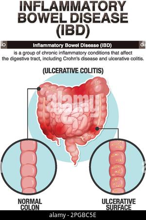 Infografica sulla malattia infiammatoria intestinale (IBD) Illustrazione Vettoriale